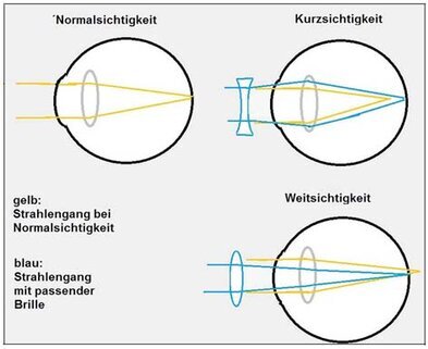Scharf sehen mit Brille